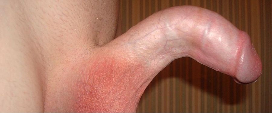 Example-of-penis-deformation