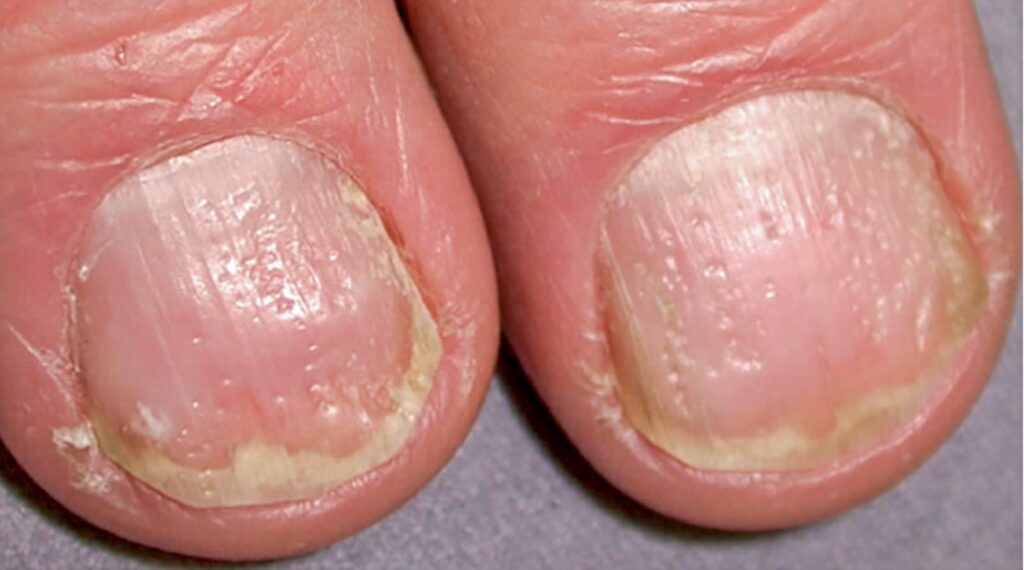 Psoriasis Disease Symptoms, Causes, Diagnosis, Treatment and Home