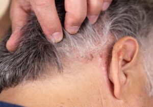 man-showing-scalp-psoriasis-symptoms
