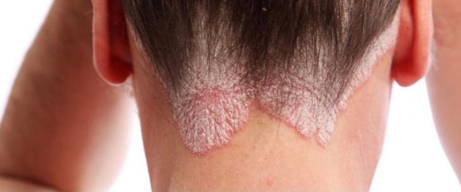 Woman Showing Symptoms of Psoriasis on Her Body