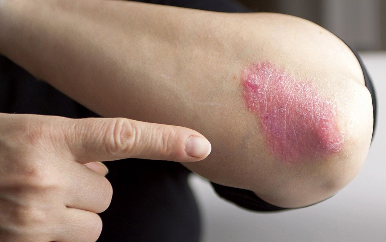 Psoriasis Disease Symptoms Causes Diagnosis Treatment And Home