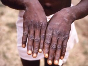 monkeypox