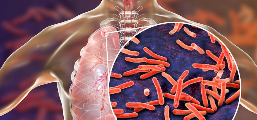 Tuberculosis: Causes, symptoms, diagnosis, prevention, BCG vaccine and treatment
