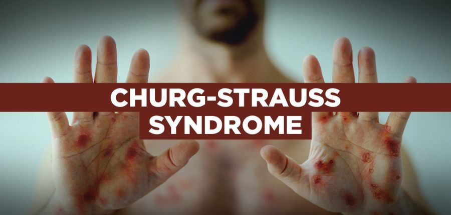 Churg-Strauss syndrome (Eosinophilic granulomatosis with polyangiitis)