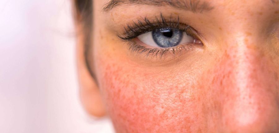 How to get rid of rosacea permanently