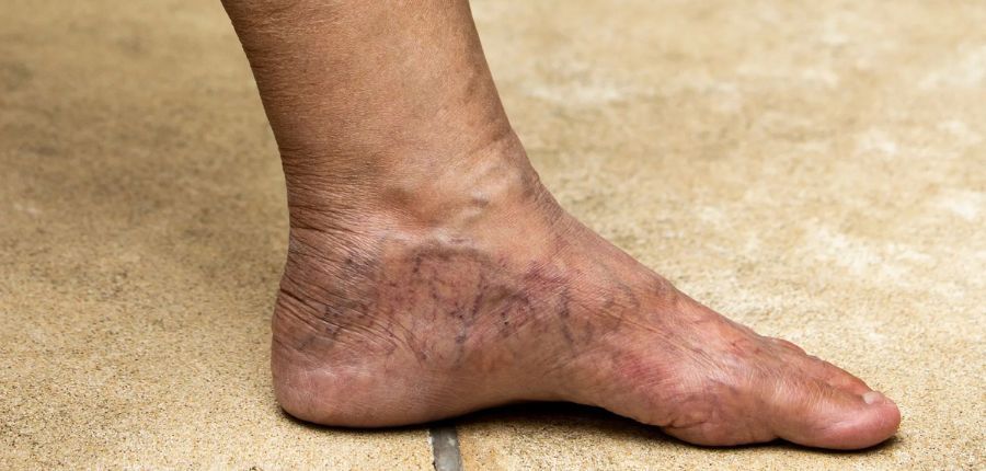 9 Natural Remedies for Varicose Veins
